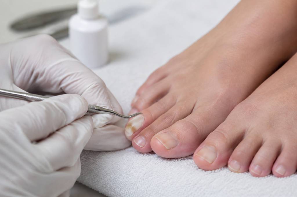 Onicogrifosis tratamiento: causas y opciones para cuidar las uñas afectadas