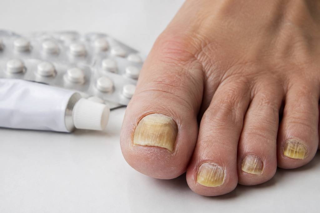 Onicogrifosis: causas, síntomas y tratamientos para las uñas engrosadas