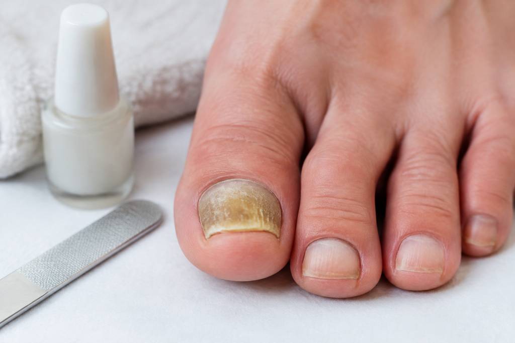 Onicogrifosis uñas: causas, síntomas y tratamientos eficaces